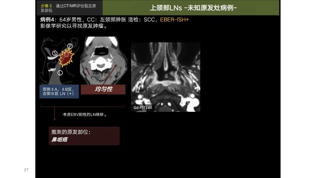 影像PPT - 【PPT】原发肿瘤在哪里？不明原发肿瘤颈部淋巴结转移的影像学检查方法-25