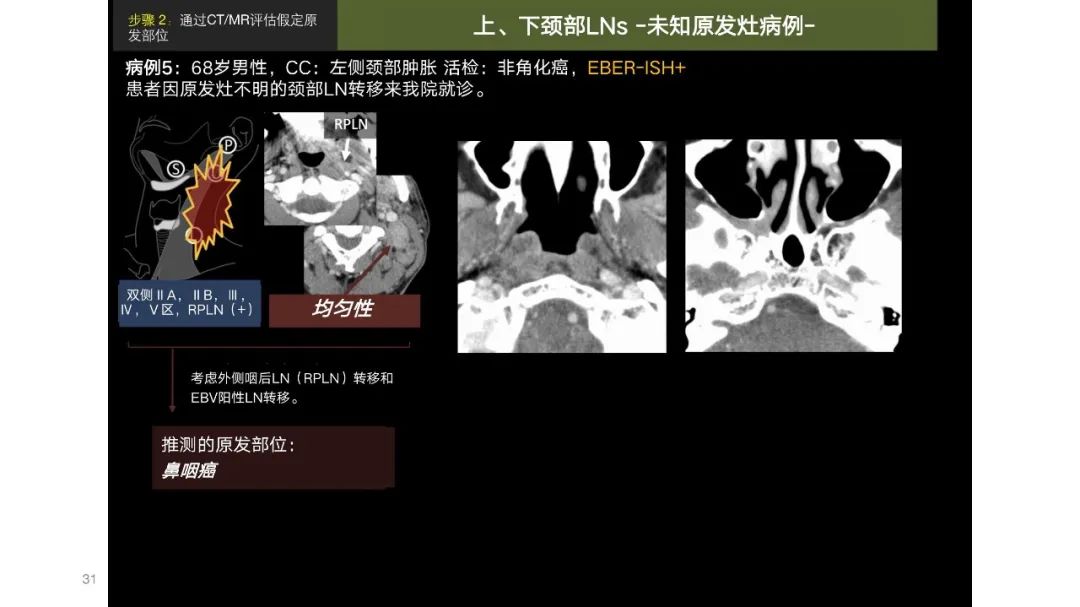 影像PPT - 【PPT】原发肿瘤在哪里？不明原发肿瘤颈部淋巴结转移的影像学检查方法-29