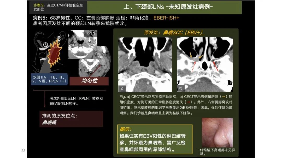 影像PPT - 【PPT】原发肿瘤在哪里？不明原发肿瘤颈部淋巴结转移的影像学检查方法-31