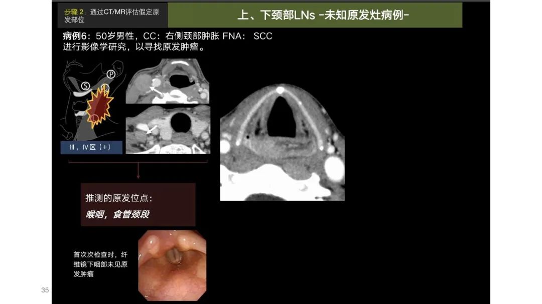 影像PPT - 【PPT】原发肿瘤在哪里？不明原发肿瘤颈部淋巴结转移的影像学检查方法-33