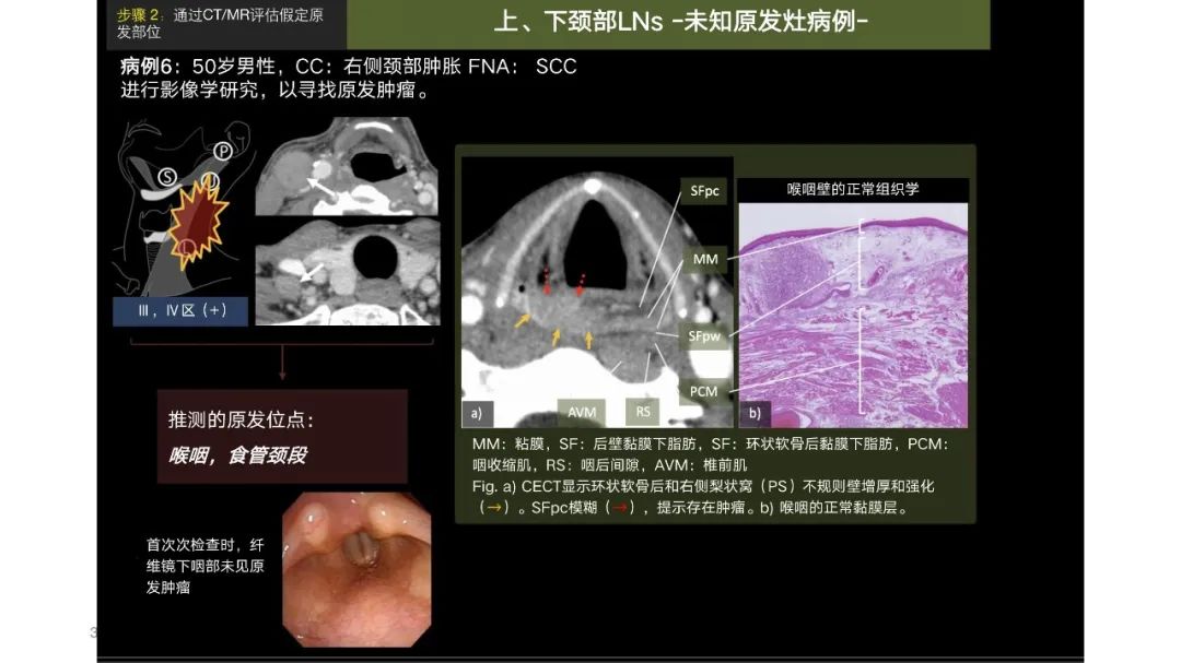 影像PPT - 【PPT】原发肿瘤在哪里？不明原发肿瘤颈部淋巴结转移的影像学检查方法-35
