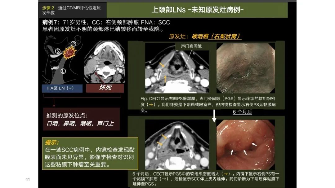 影像PPT - 【PPT】原发肿瘤在哪里？不明原发肿瘤颈部淋巴结转移的影像学检查方法-39