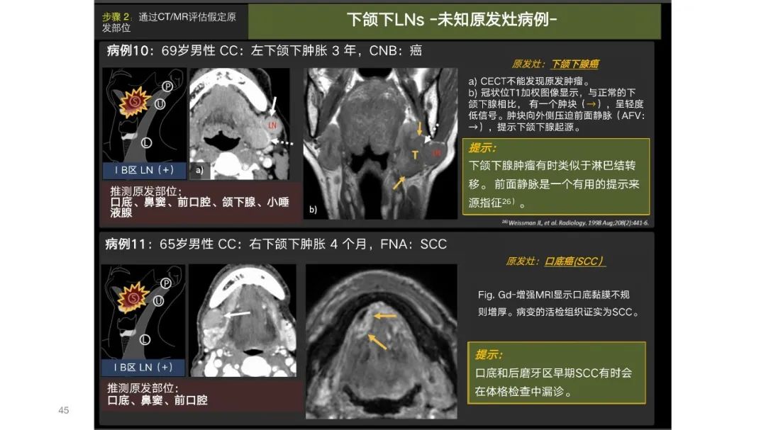 影像PPT - 【PPT】原发肿瘤在哪里？不明原发肿瘤颈部淋巴结转移的影像学检查方法-43
