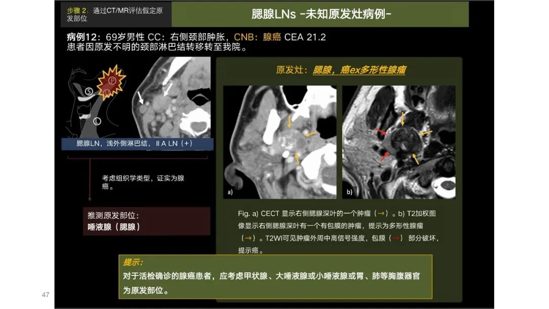 影像PPT - 【PPT】原发肿瘤在哪里？不明原发肿瘤颈部淋巴结转移的影像学检查方法-45