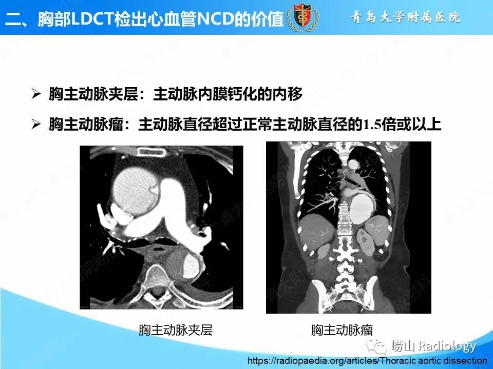 影像PPT - 【PPT】胸部低剂量CT肺癌筛查在检出其他常见慢性非传染性疾病的价值-6