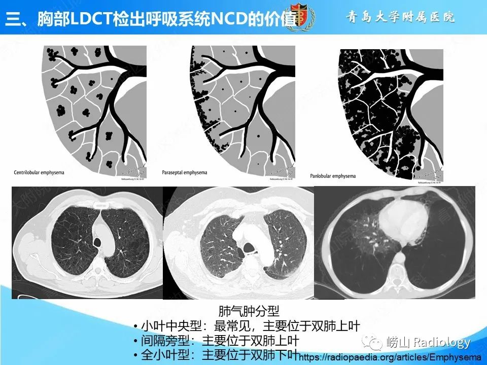 影像PPT - 【PPT】胸部低剂量CT肺癌筛查在检出其他常见慢性非传染性疾病的价值-8