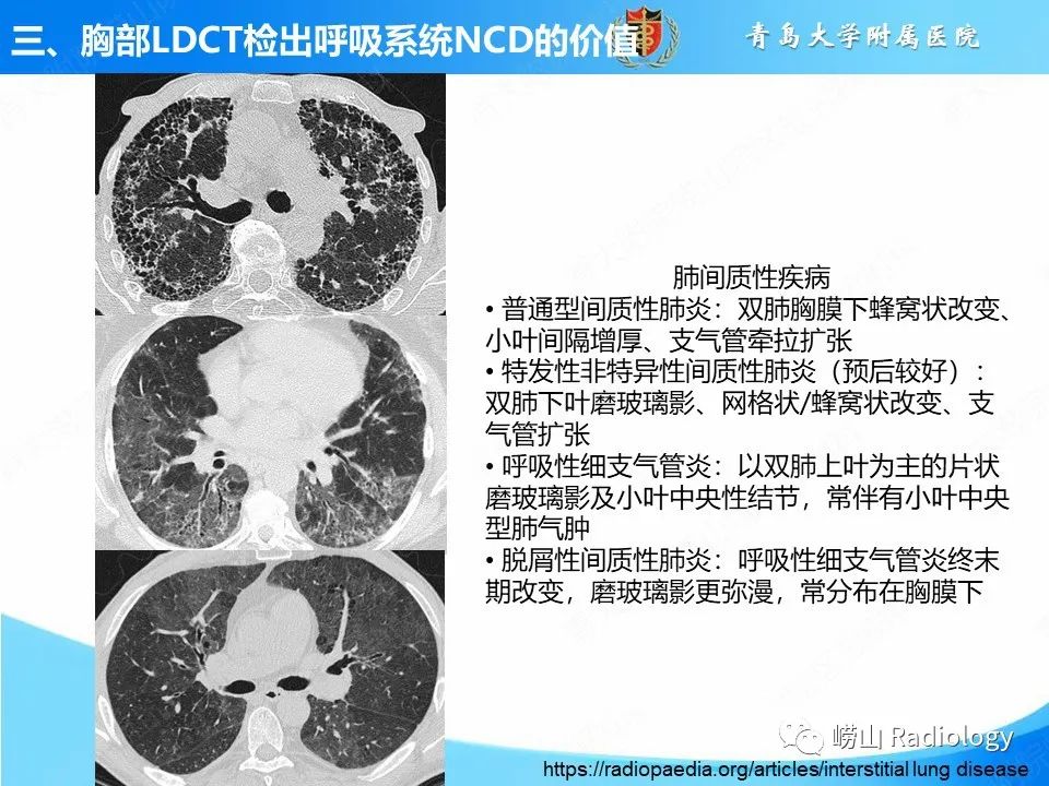 影像PPT - 【PPT】胸部低剂量CT肺癌筛查在检出其他常见慢性非传染性疾病的价值-10