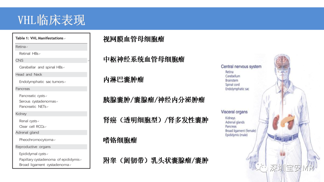 影像PPT - 【PPT】VHL综合症及相关肿瘤-4