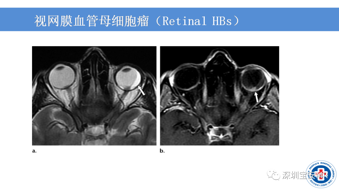 影像PPT - 【PPT】VHL综合症及相关肿瘤-11