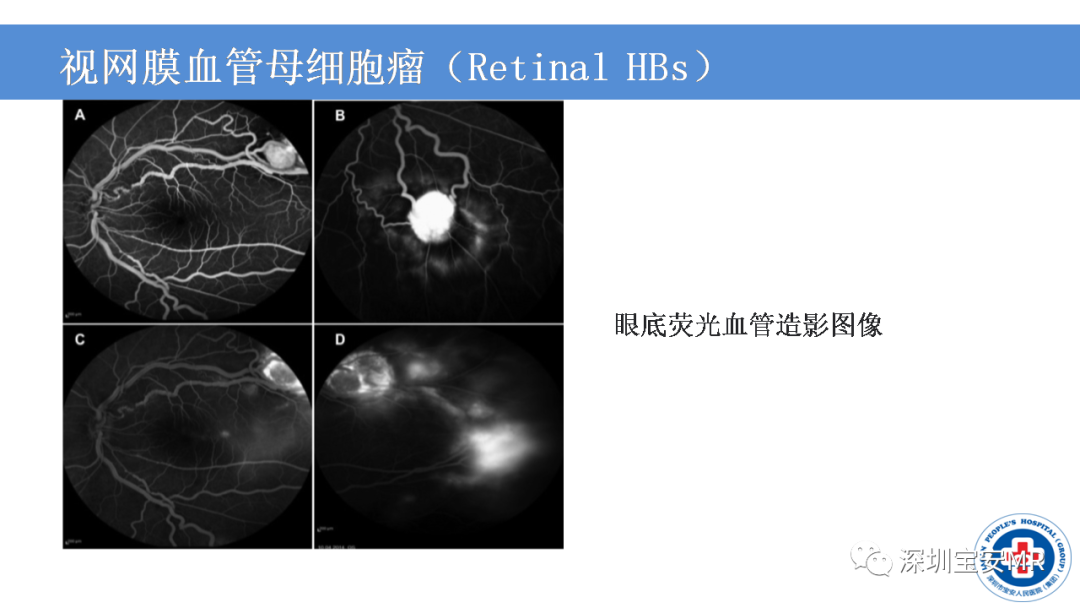 影像PPT - 【PPT】VHL综合症及相关肿瘤-12