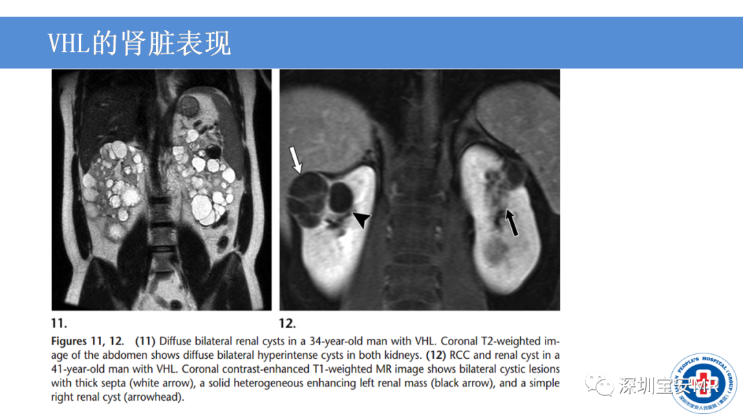 影像PPT - 【PPT】VHL综合症及相关肿瘤-26