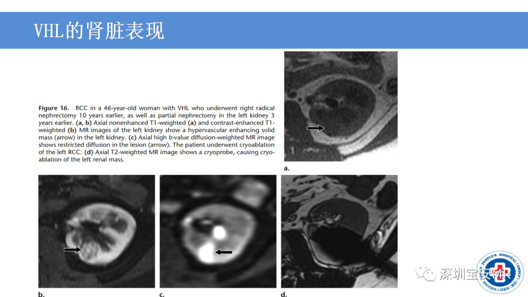 影像PPT - 【PPT】VHL综合症及相关肿瘤-28