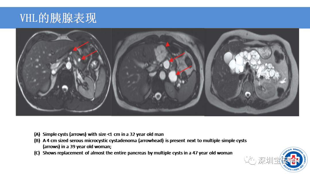 影像PPT - 【PPT】VHL综合症及相关肿瘤-33