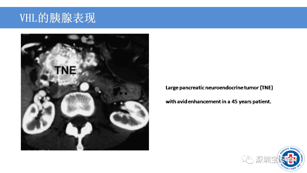 影像PPT - 【PPT】VHL综合症及相关肿瘤-34