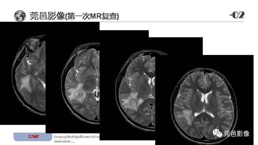 影像PPT - 【病例】血管中心性胶质瘤一例分析-6