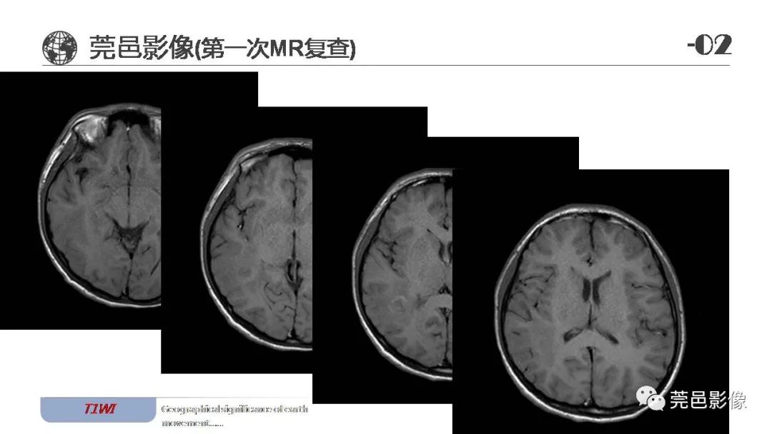 影像PPT - 【病例】血管中心性胶质瘤一例分析-7