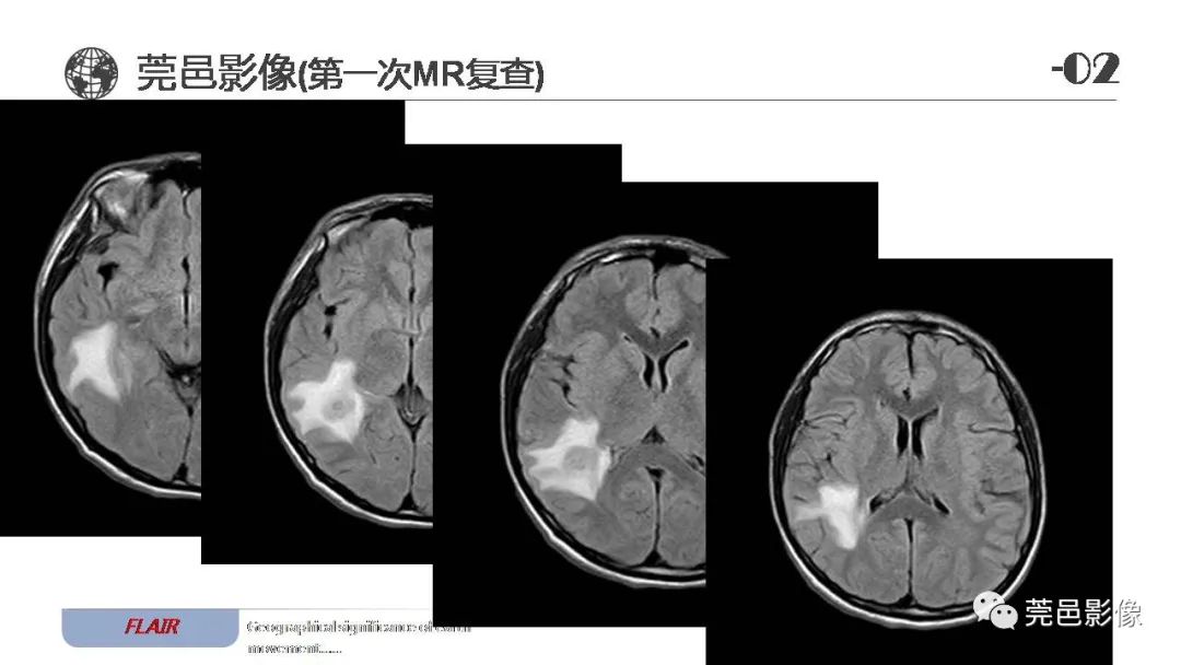 影像PPT - 【病例】血管中心性胶质瘤一例分析-8