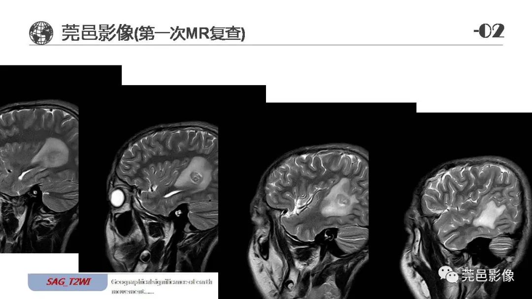 影像PPT - 【病例】血管中心性胶质瘤一例分析-9