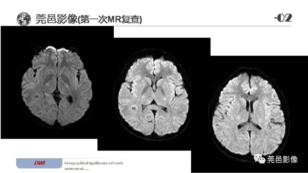 影像PPT - 【病例】血管中心性胶质瘤一例分析-10