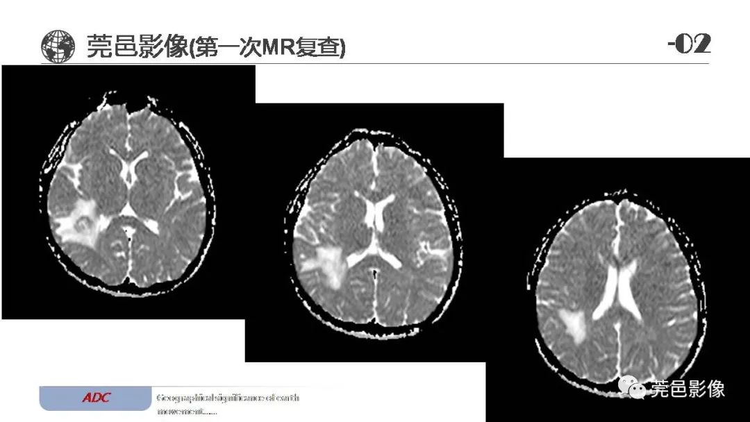 影像PPT - 【病例】血管中心性胶质瘤一例分析-11