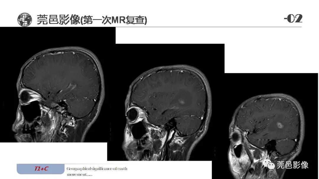 影像PPT - 【病例】血管中心性胶质瘤一例分析-12