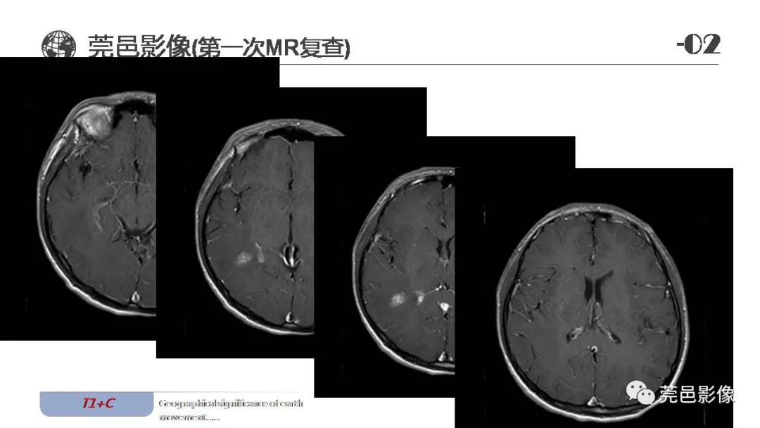 影像PPT - 【病例】血管中心性胶质瘤一例分析-13