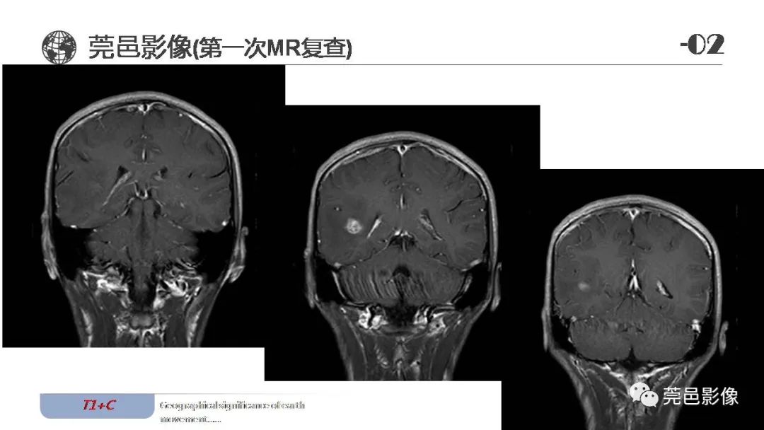 影像PPT - 【病例】血管中心性胶质瘤一例分析-14