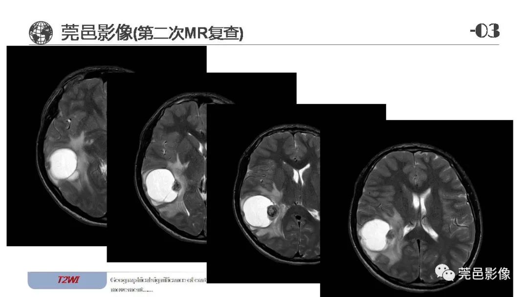 影像PPT - 【病例】血管中心性胶质瘤一例分析-16