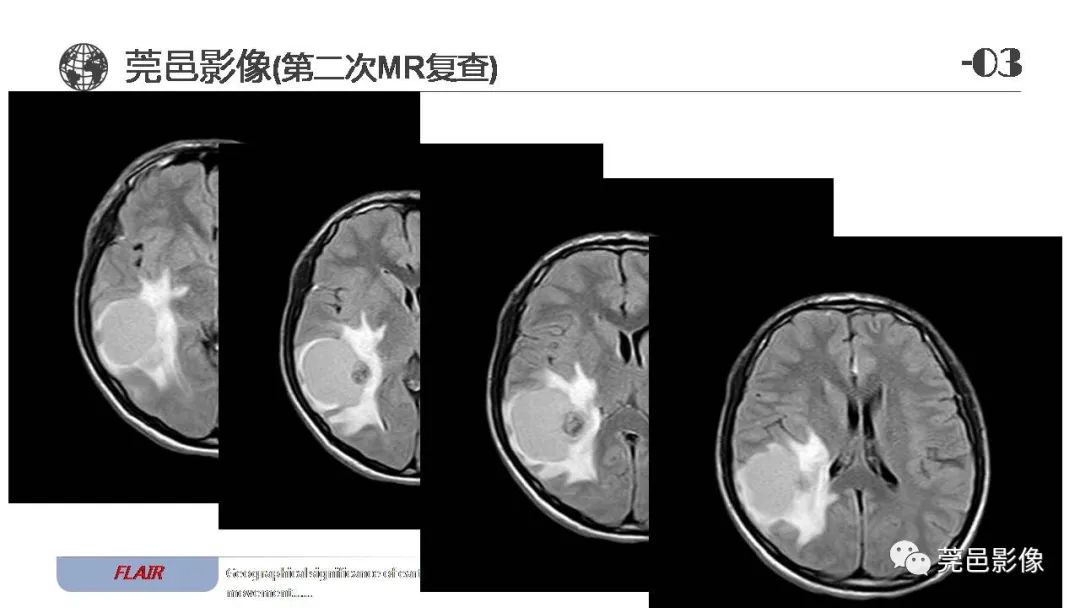 影像PPT - 【病例】血管中心性胶质瘤一例分析-18