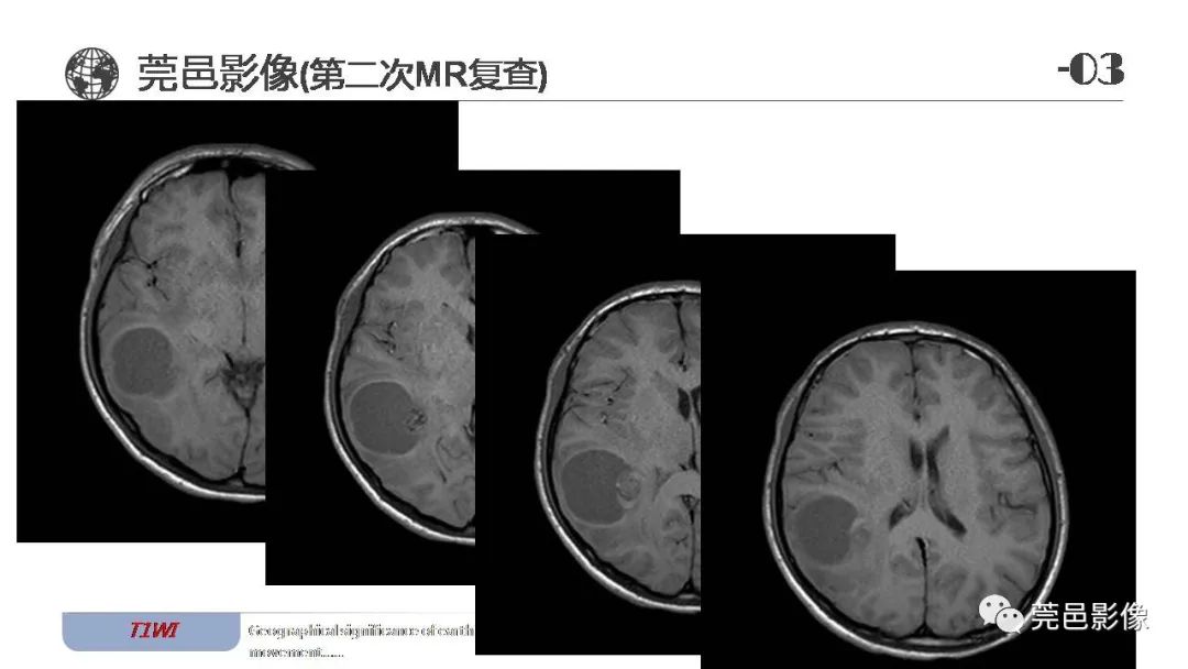 影像PPT - 【病例】血管中心性胶质瘤一例分析-17