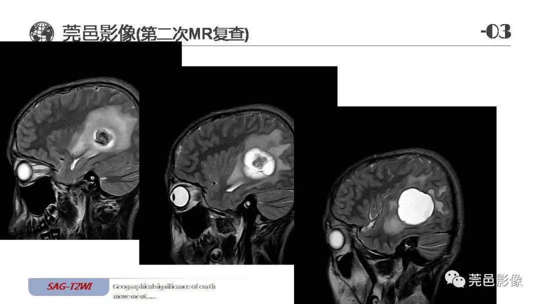 影像PPT - 【病例】血管中心性胶质瘤一例分析-19