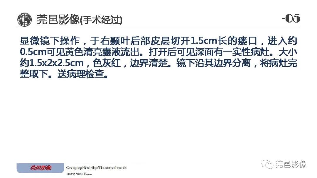 影像PPT - 【病例】血管中心性胶质瘤一例分析-22