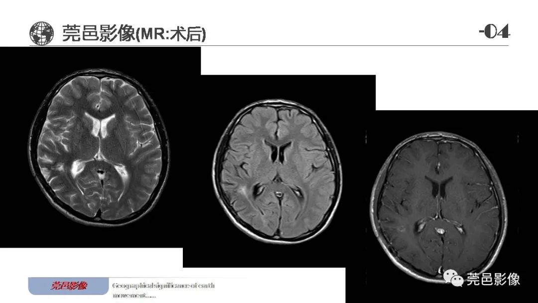 影像PPT - 【病例】血管中心性胶质瘤一例分析-21