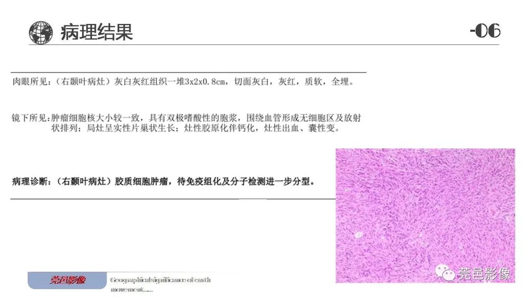 影像PPT - 【病例】血管中心性胶质瘤一例分析-23