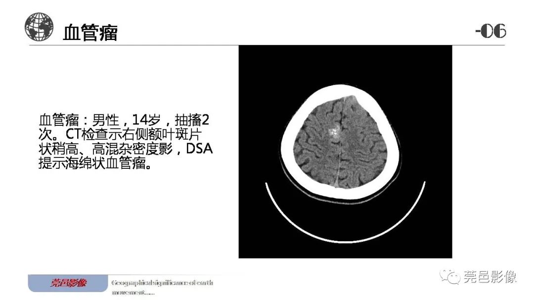 影像PPT - 【病例】血管中心性胶质瘤一例分析-29