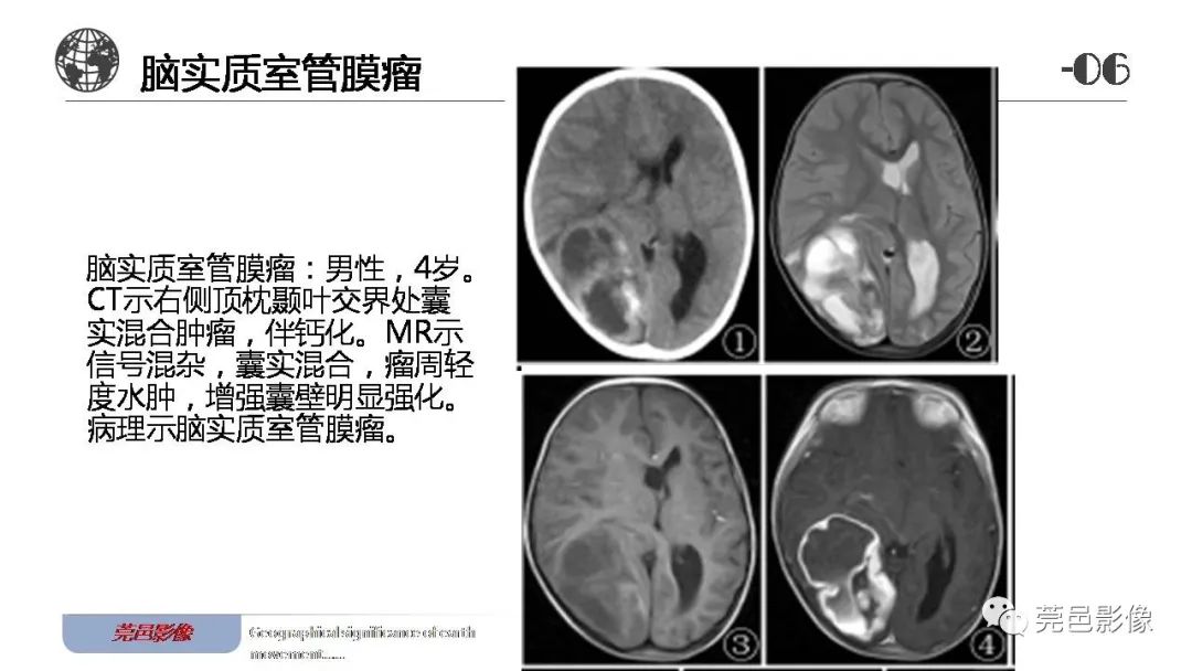 影像PPT - 【病例】血管中心性胶质瘤一例分析-30
