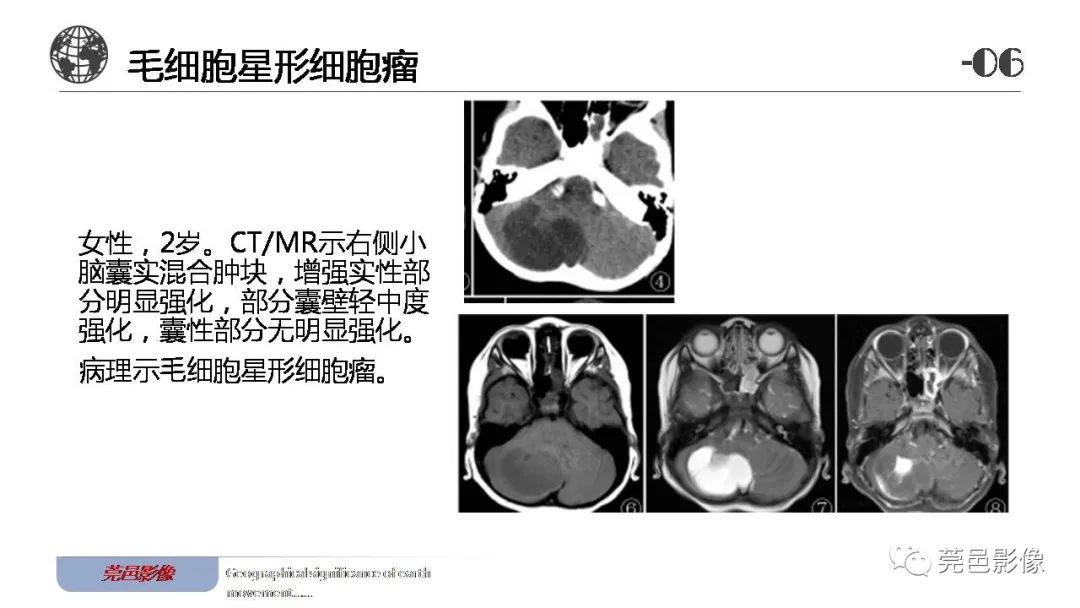 影像PPT - 【病例】血管中心性胶质瘤一例分析-31