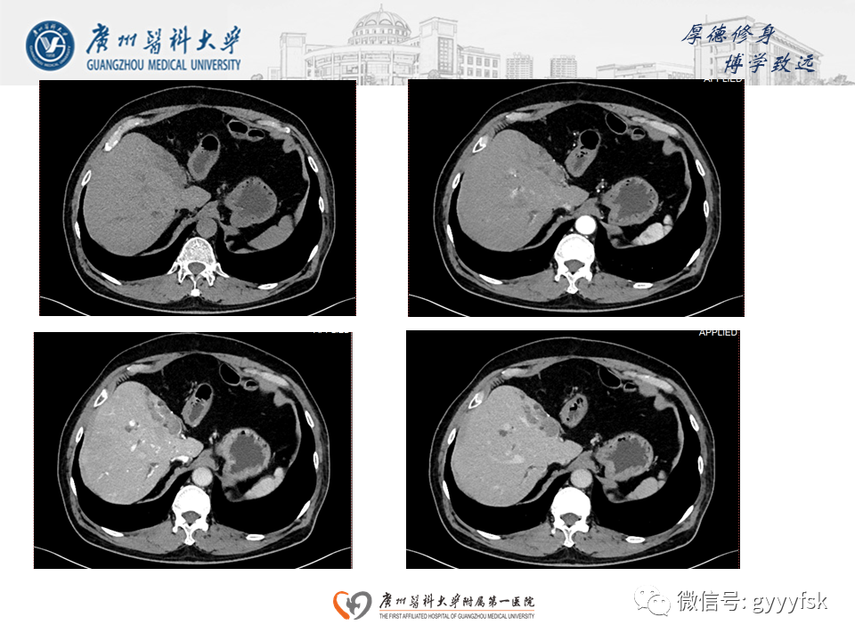 影像PPT - 【PPT】胆管导管内乳头状肿瘤(IPNB)-4