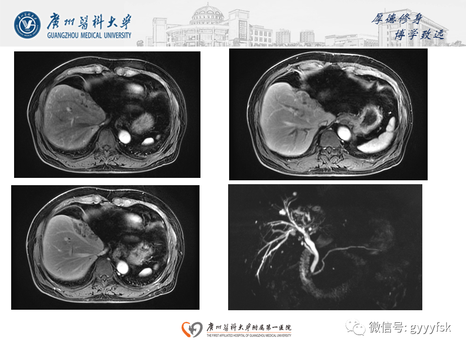 影像PPT - 【PPT】胆管导管内乳头状肿瘤(IPNB)-6