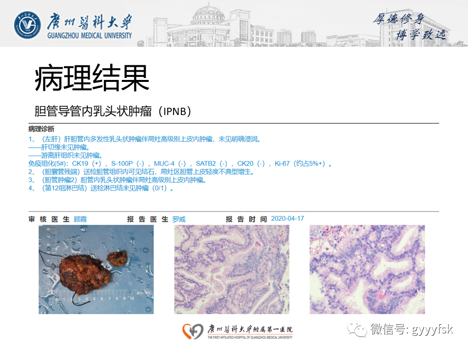 影像PPT - 【PPT】胆管导管内乳头状肿瘤(IPNB)-8