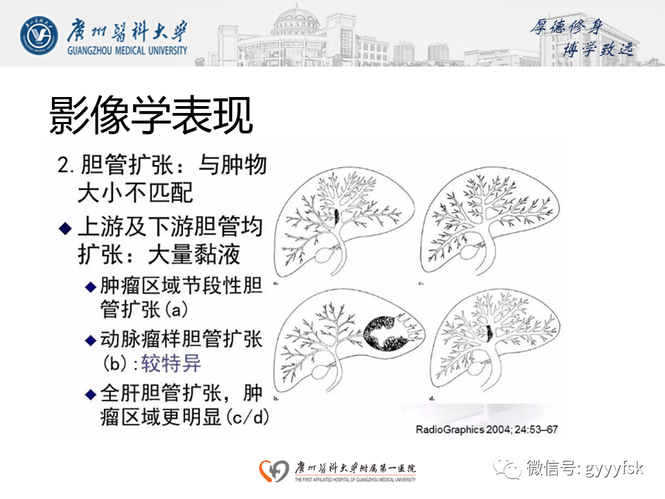 影像PPT - 【PPT】胆管导管内乳头状肿瘤(IPNB)-16