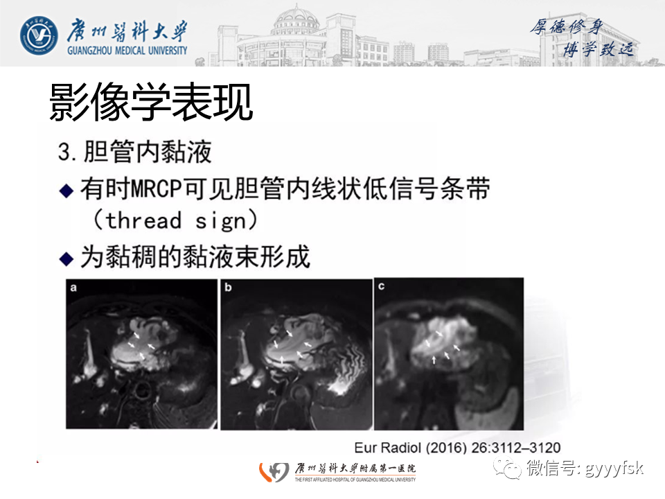影像PPT - 【PPT】胆管导管内乳头状肿瘤(IPNB)-17