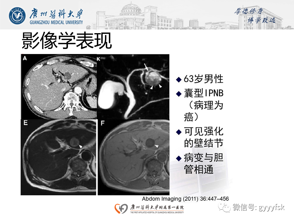 影像PPT - 【PPT】胆管导管内乳头状肿瘤(IPNB)-18