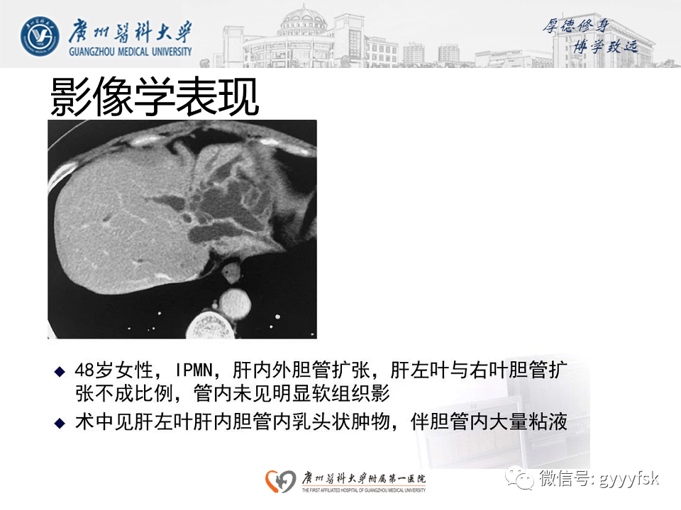 影像PPT - 【PPT】胆管导管内乳头状肿瘤(IPNB)-19
