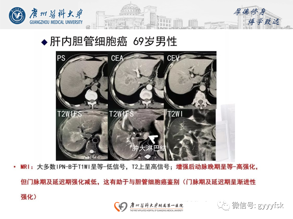 影像PPT - 【PPT】胆管导管内乳头状肿瘤(IPNB)-22
