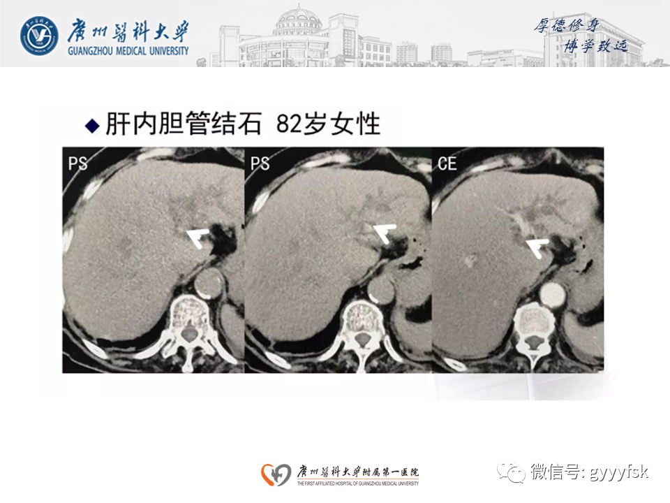 影像PPT - 【PPT】胆管导管内乳头状肿瘤(IPNB)-23