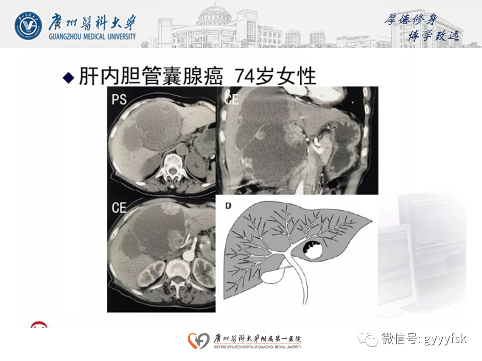 影像PPT - 【PPT】胆管导管内乳头状肿瘤(IPNB)-24