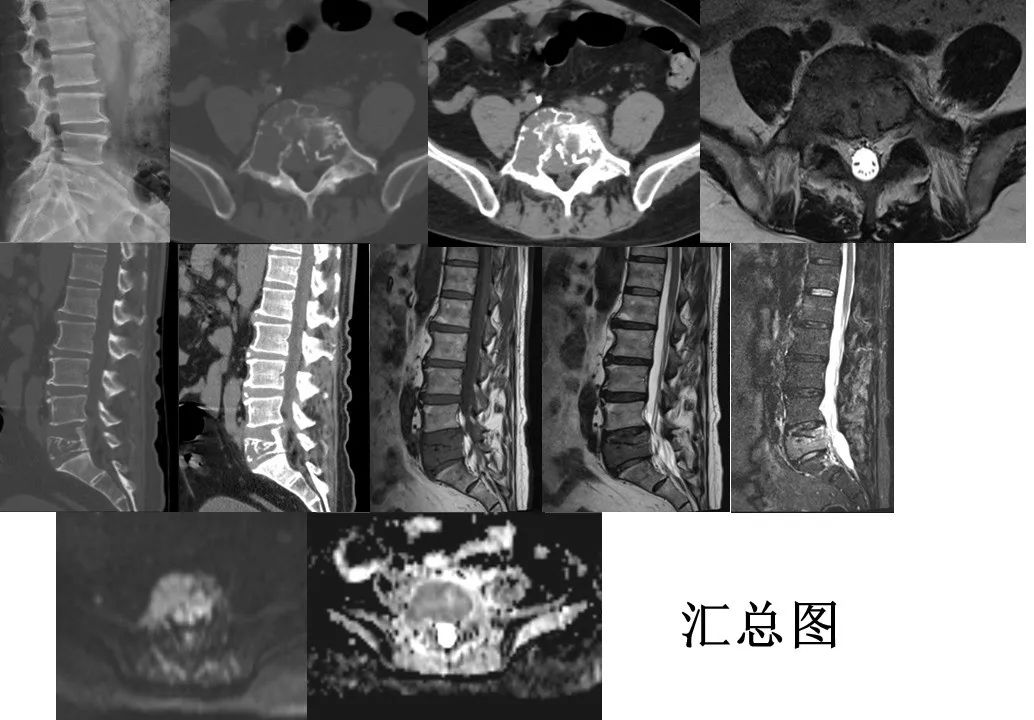 影像PPT - 【病例】椎体恶性外周神经鞘瘤 VS 浆细胞瘤-8