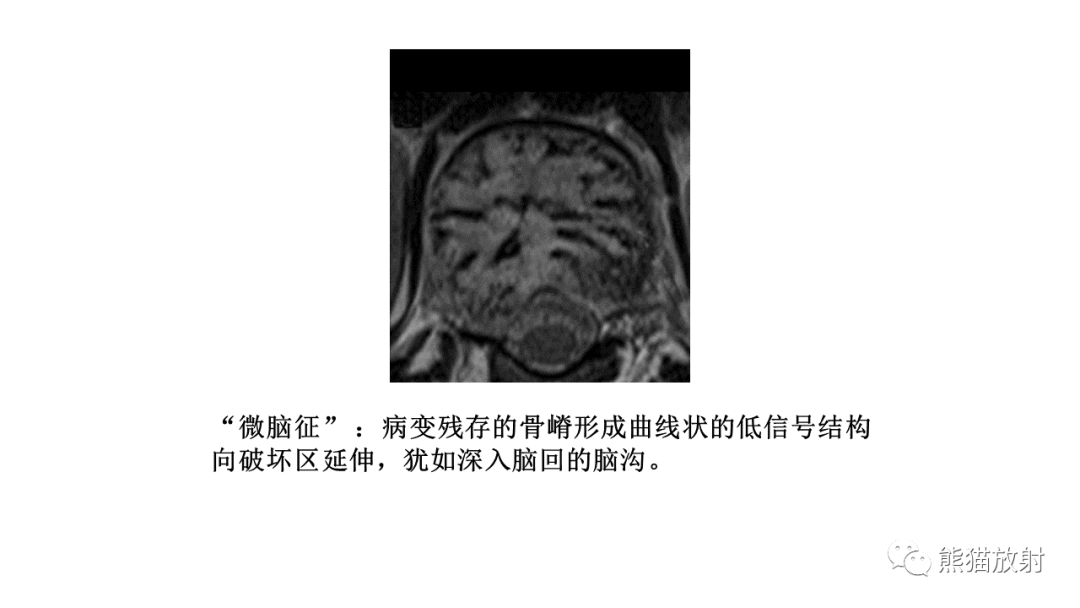 影像PPT - 【病例】椎体恶性外周神经鞘瘤 VS 浆细胞瘤-24