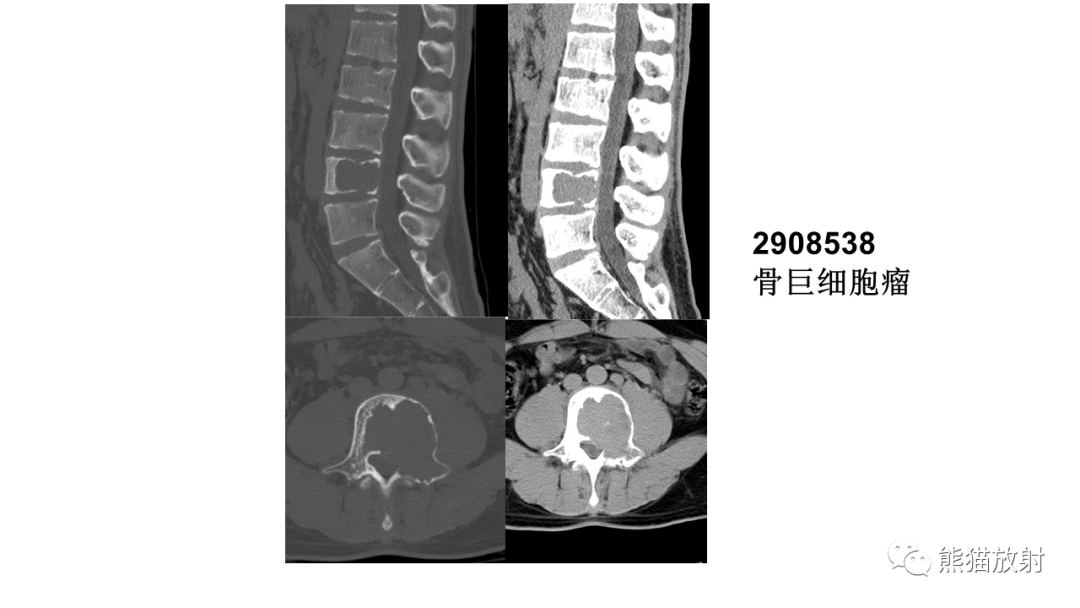 影像PPT - 【病例】椎体恶性外周神经鞘瘤 VS 浆细胞瘤-32